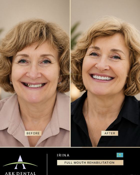 Irina from Kazakhstan: full mouth rehabilitation