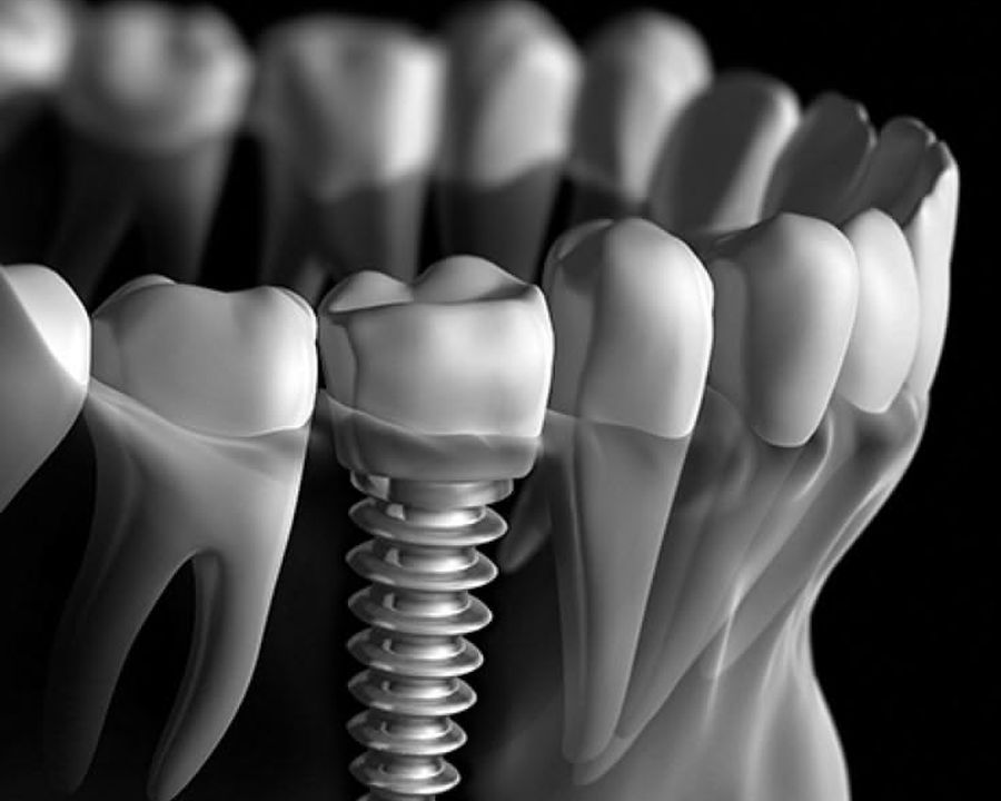 Dental implant anatomy: titanium post, abutment and crown in the jawbone