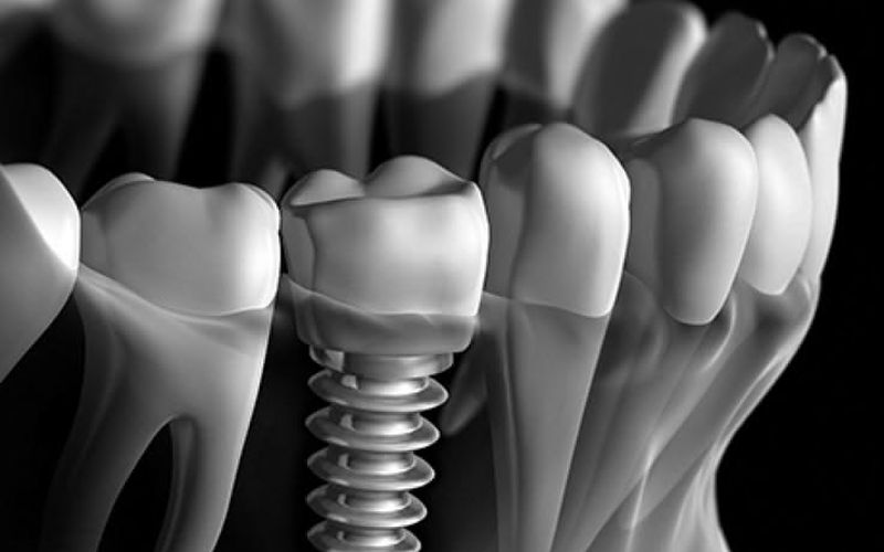 Dental implant package for international patients