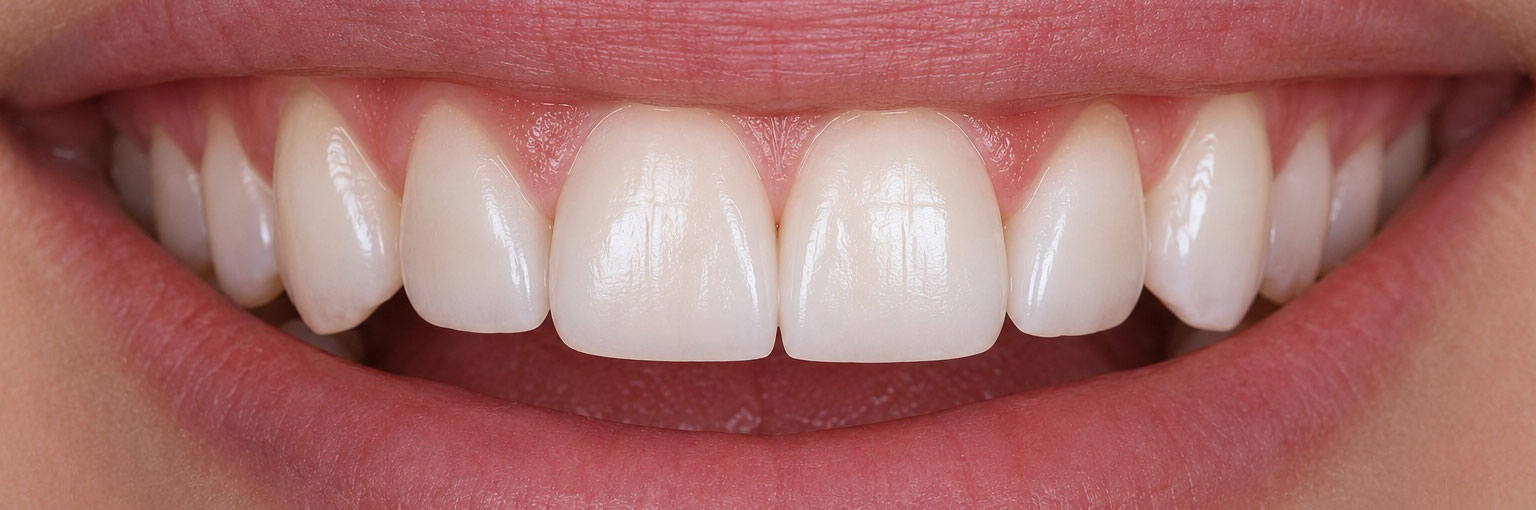 After — 2 porcelain veneers covering chips