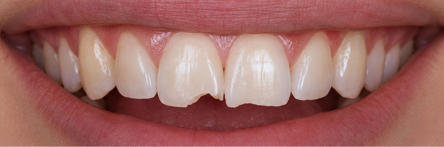Before — chipped front teeth