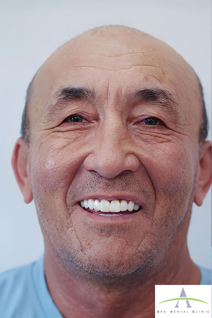 After Invisalign treatment — perfectly straight smile