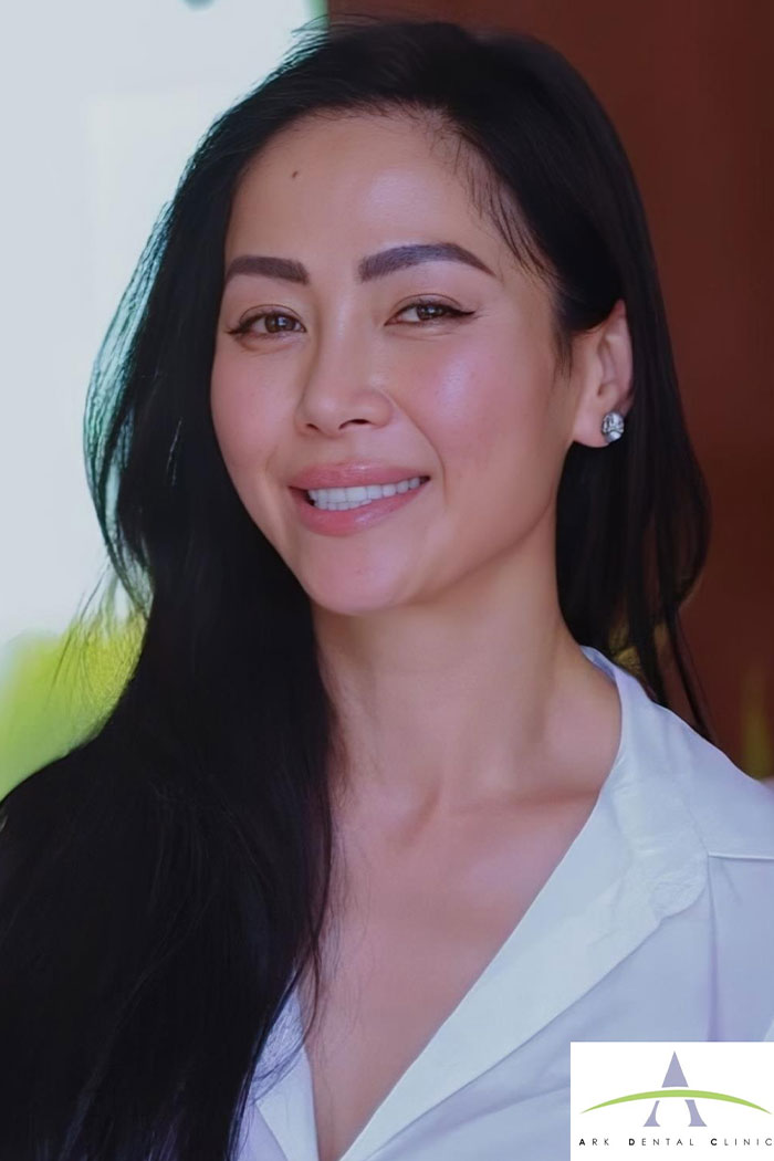 After Straumann dental implant — natural-looking restoration