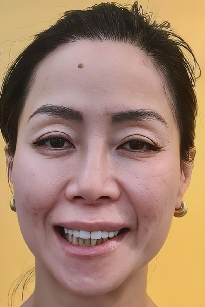 Before dental implant — missing tooth